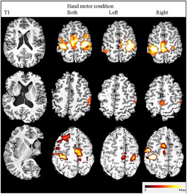 Upper Limb Function and Cortical Organization in Youth with Unilateral Cerebral Palsy